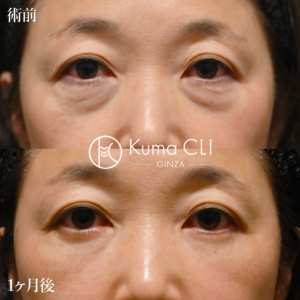 表ハムラ法＋ナノリッチ